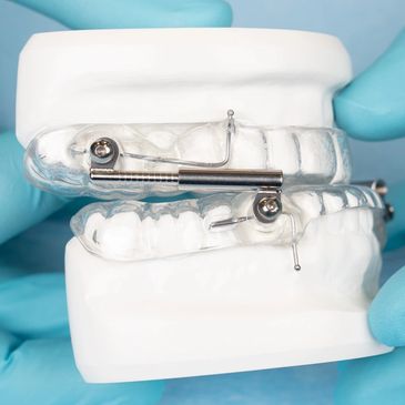 custom mandibular advancement device
