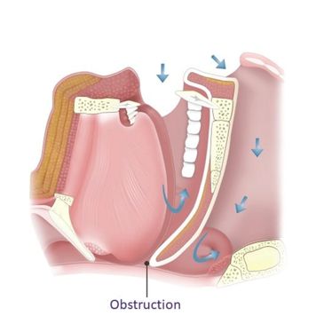 blocked airway from sleep apnea
