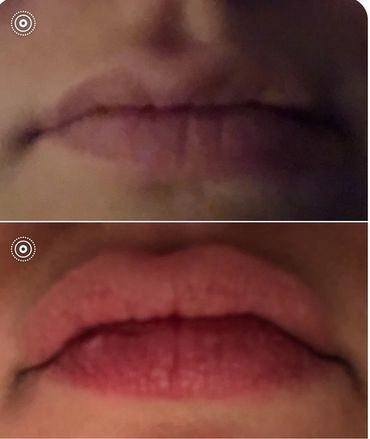Lip pops are a great way for those who want a fuller top lip before committing to filler