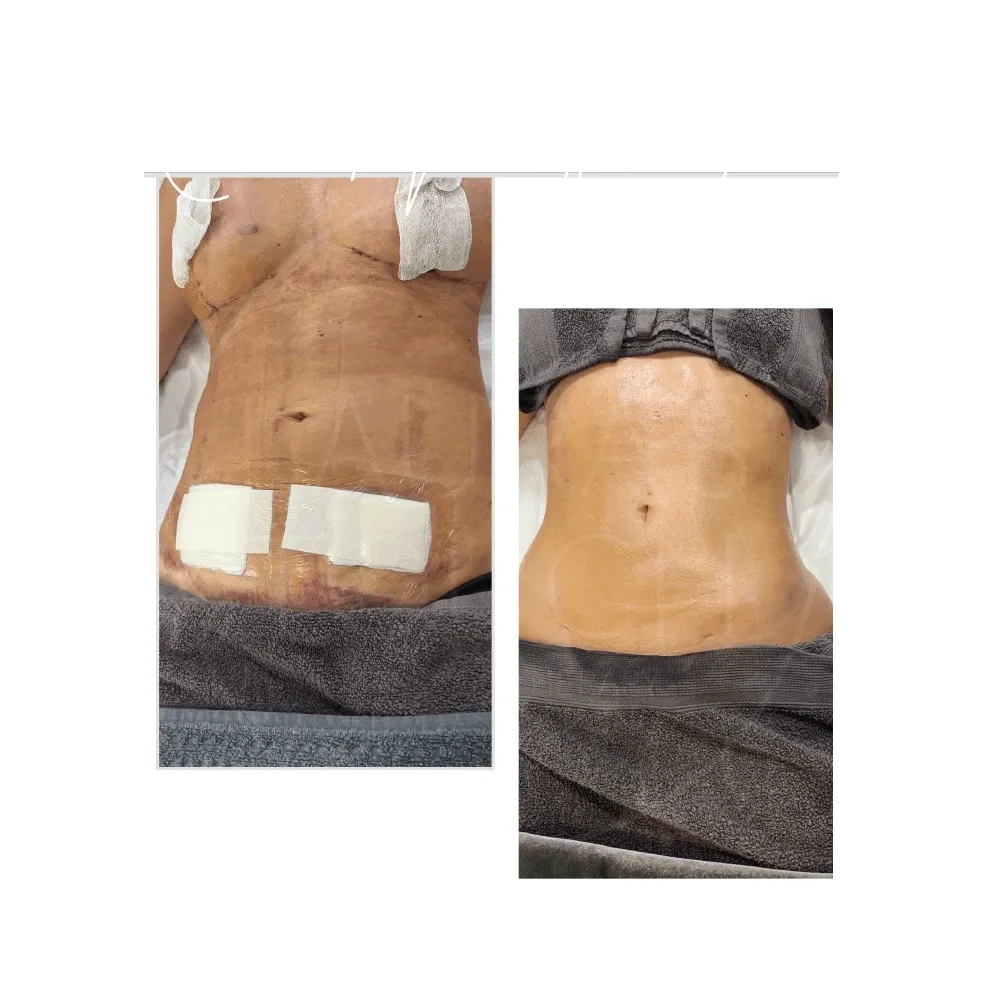 Plastic Surgery Lymphatic Drainage Massage