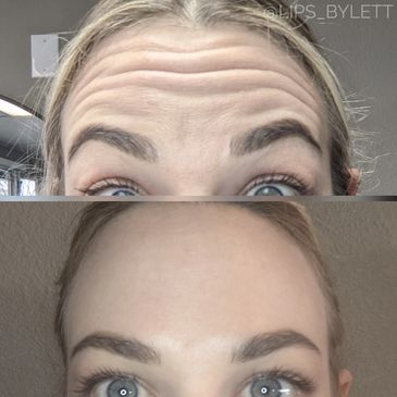 Comparison of forehead with wrinkles and smooth skin.