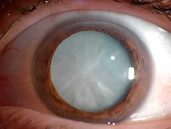 Cloudy white cataract