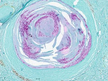 An acid fast stained granuloma from a fish with mycobacteriosis; photo by Dr. Ryan Oliveira.