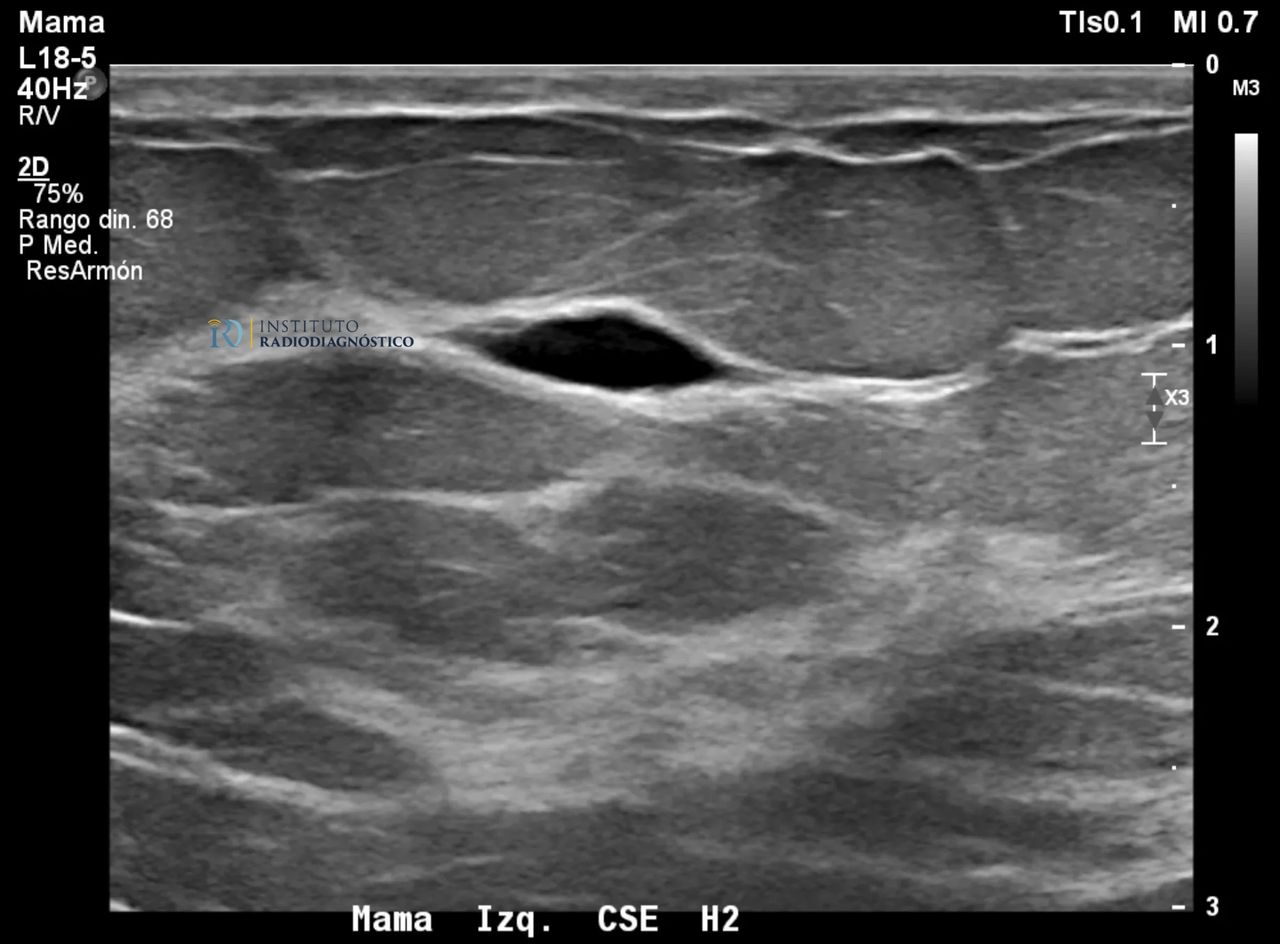 Qué son los quistes mamarios y cómo se manejan?, image size:1280x944
