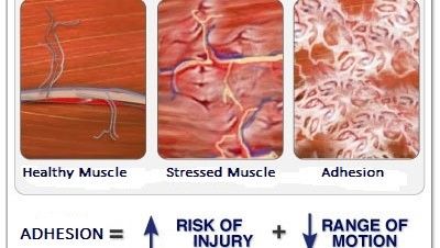 Corrective Exercise, Muscle Adhesion, Physical Therapy, Myofascial release