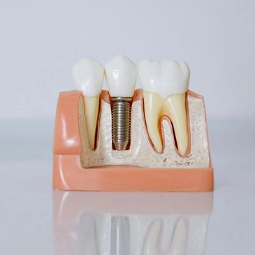 Dr. Joshua Profitt Implants, Implantology, NS Dental Implant, Dental Implants Halifax Dental Implant