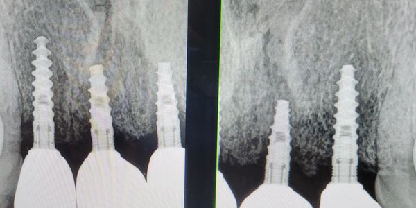 Radiografia de Implantes Dentales