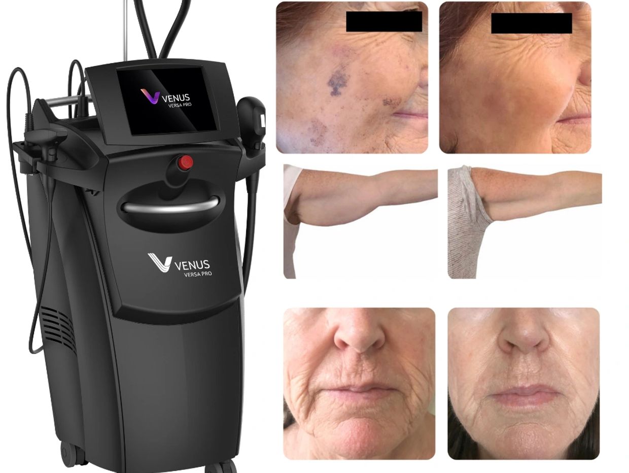 Venus Versa Pro machine with skin treatment before and after photos.