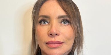 hair-thinning-liverpool-before.webp