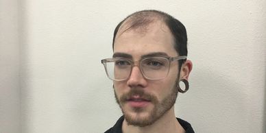 mens-hair-loss-liverpool-before.webp