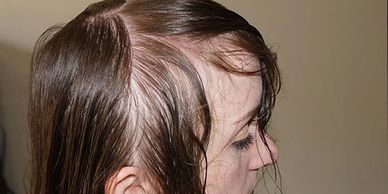 alopecia-hair-loss-liverpool.webp