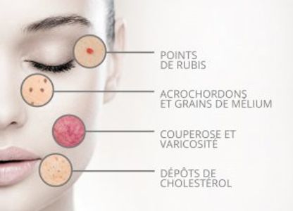 thermocoagulation pour les capillaires sanguins , les grain de mélium , les varicosité et couperose rougeurs 