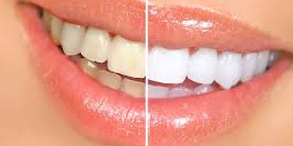 Before and after cosmetic dentistry services in Huntington Beach, CA