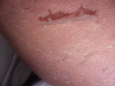 Tiff’s Skin swollen, red, raw, and peeling around the area above her abdominal implant.