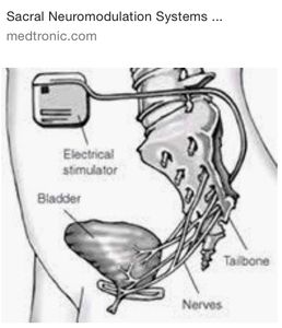 A diagram of Tiff’s Medtronic bladder implant, showing its placement and wiring inside to the spine.