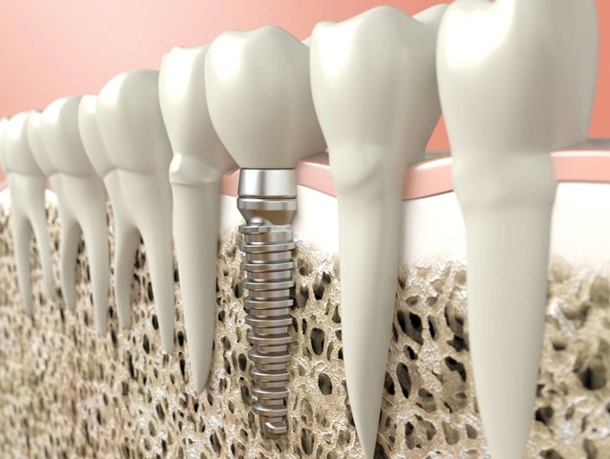 3D illustration showing a dental implant integrated with natural teeth and jawbone.