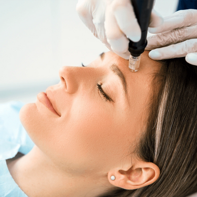 Microneedling Treatment Bromsgrove