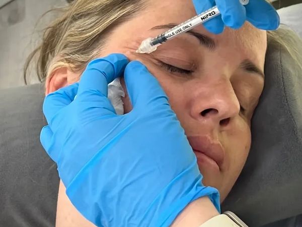 Tratamiento de arrugas de expresión  con Toxina Botulínica en Castelldefels