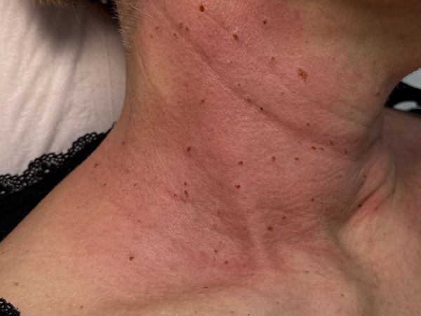 Cuello con múltiples lunares y pecas.