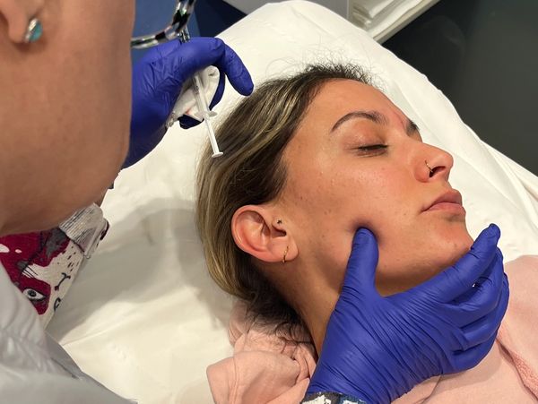 Tratamiento de arrugas de expresión  con Toxina Botulínica en Castelldefels