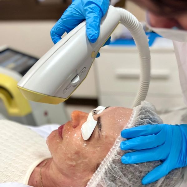 Tratamiento de rejuvenecimiento facial y eliminación de manchas con laser IPL