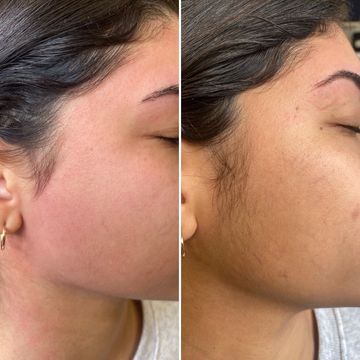 epilation visage au fil