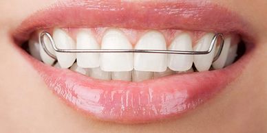 Close-up of a smile with a dental retainer on upper teeth.