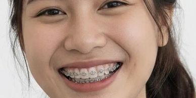 Smiling young woman with braces and tied-back hair.