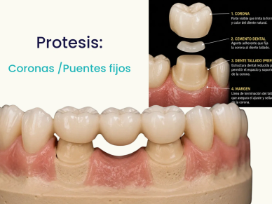 Illustration of fixed dental crowns and bridges prosthesis.
