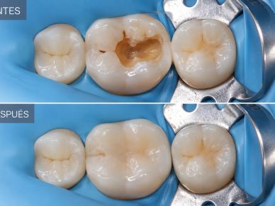 Dental cavity treatment showing before and after restoration.