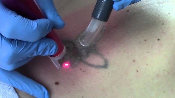 Laser tattoo removal in progress on skin with blue gloves handling devices.