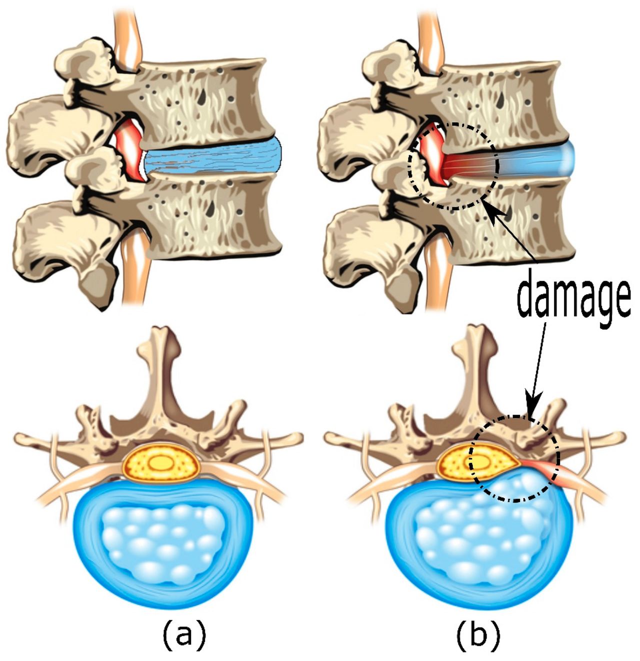 Functional Spinal Unit displaying disc bulge in the spine. Functional Spinal Unit displaying disc bulge in the spine.