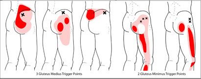 Trigger point map showing referred pain from the gluteal muscle down the leg Trigger point map showing referred pain from the gluteal muscle down the leg