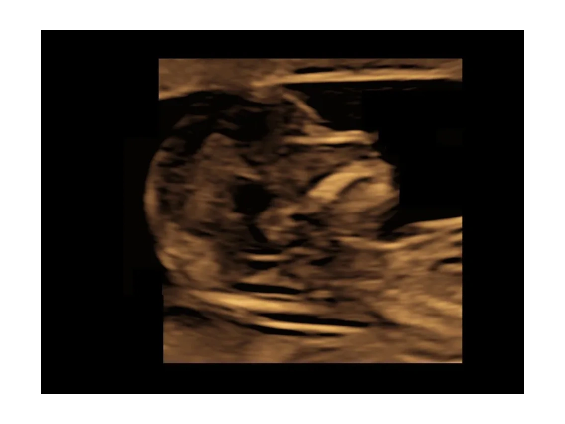 Thirdmonth scan NTNB scan Is it essential? Why and when?