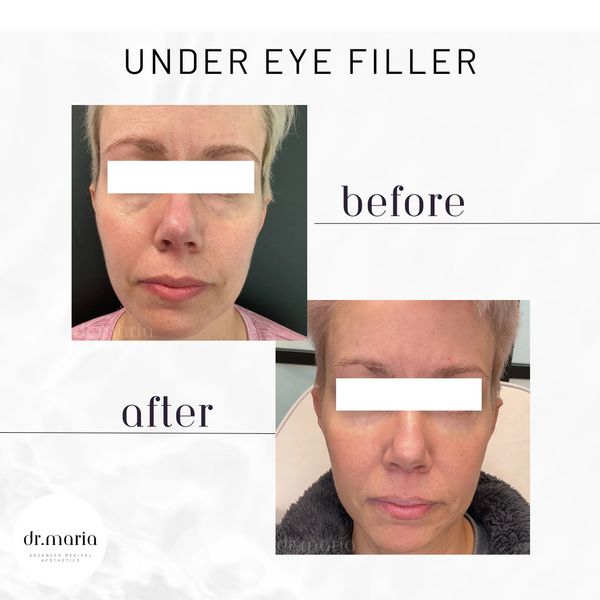 Dermal filler