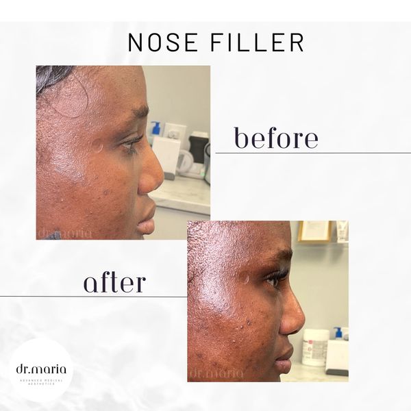 Liquid rhinoplasty