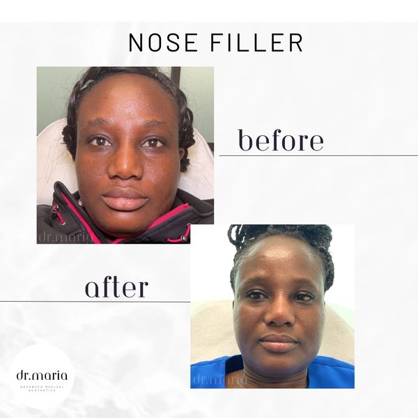 Nose Filler