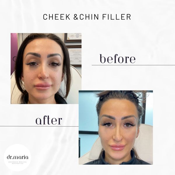 chin filler