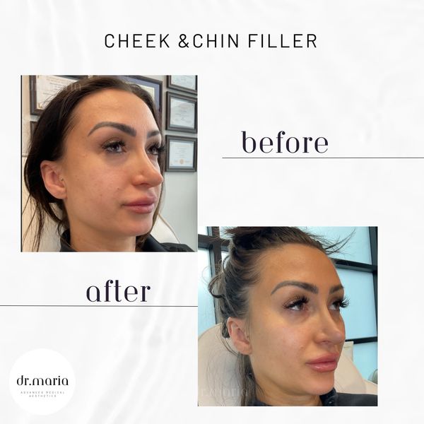 Cheek filler