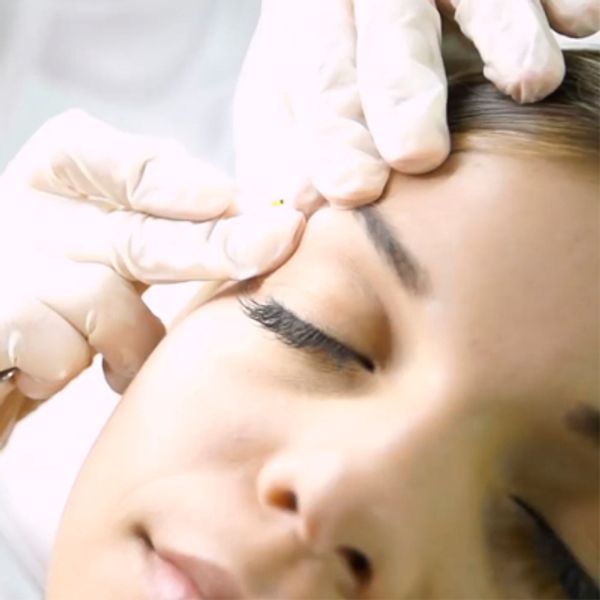 depilación eléctrica vello hormonal, blanco y tatuajes