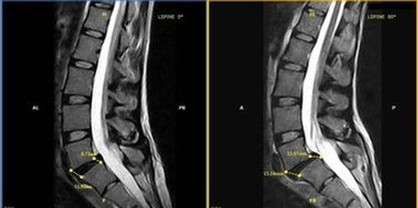 Regular MRI vs a Stand Up MRI you can really see the injury with weight added to your exam