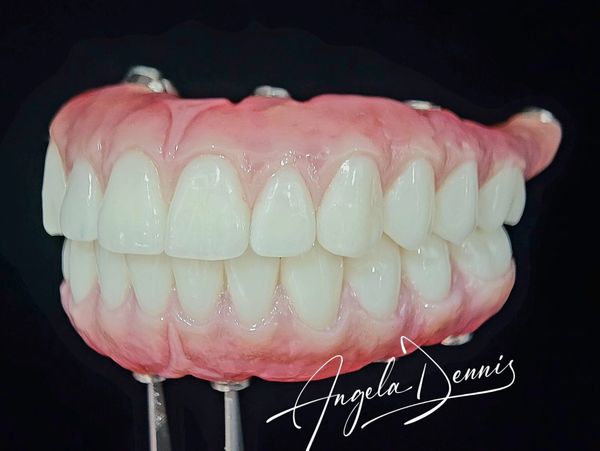 An All-on-X acrylic wrap on TiBar fixed bridge, characterized using composite.