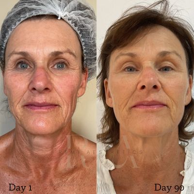 Skin resurfacing, Skin texture, skin remodeling, skin needling, microneedling, RF 