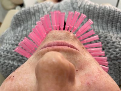 PDO threads, collagen boosting 