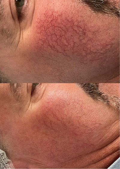 Broken capillaries, sun spots, sun damage, smooth textured skin