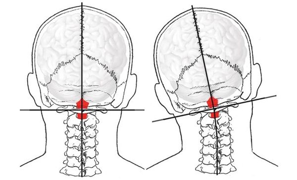 Comparison of head posture aligned and tilted views.