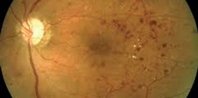 Diabetic Retinopathy, 