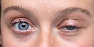 Ptosis 