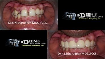 Smile designing 