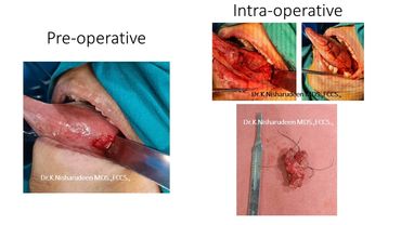 oral cancer treatment